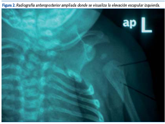 Figura 2. Radiografía anteroposterior ampliada donde se visualiza la elevación escapular izquierda.